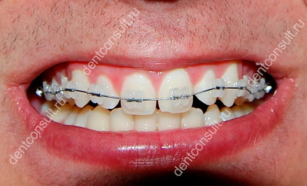Брекеты на верхнюю челюсть. Сколько ставят брекеты на верхнюю челюсть. Mini uni twin брекеты. Ровные зубы. Сколько ставят брекеты на верхнюю челюсть.