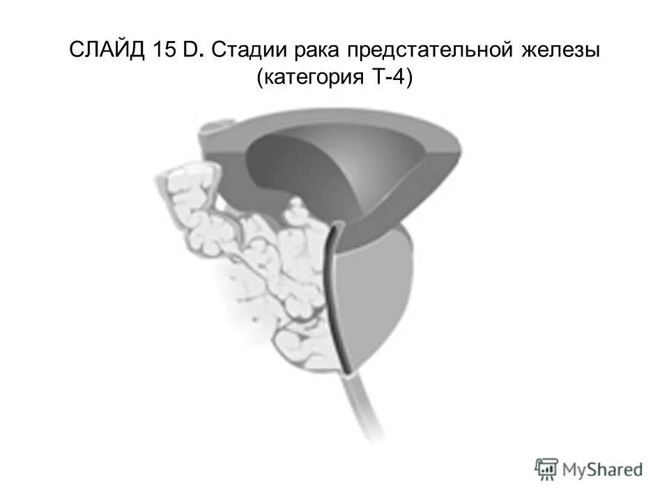 Рецидив предстательной железы