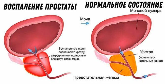 Может ли болеть простата