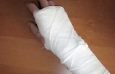 Рука девушки в гипсе
