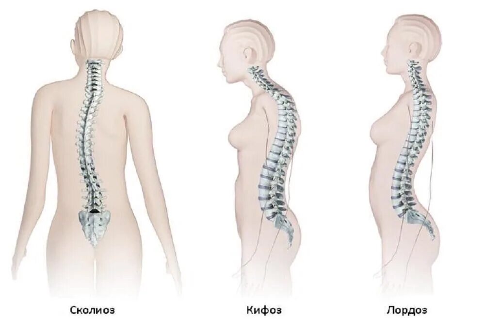 Усиленный лордоз. Кифоз и лордоз поясничного отдела. Деформации позвоночника кифоз лордоз сколиоз. Скелет позвоночника лордоз кифоз. Искривление грудного отдела позвоночника кифоз.