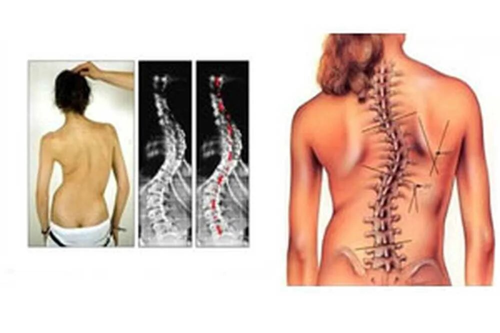 Инвалидность сколиоз 2 степени. Сколиоз отдела позвоночника 3 степени. Операция на позвоночнике сколиоз 4 степени. Сколиоз позвоночника 3 степени инвалидность.