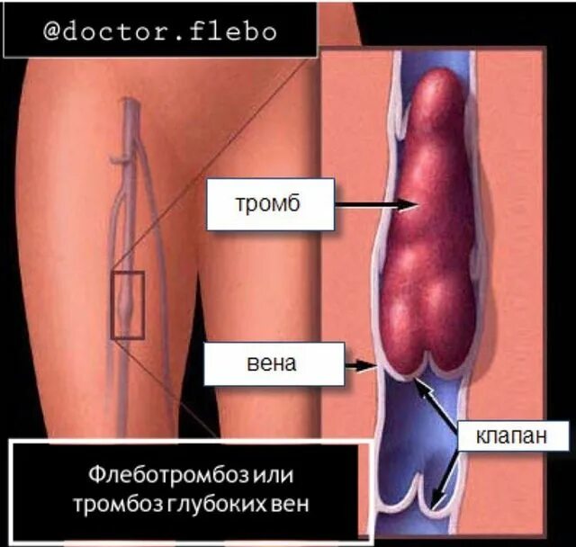 Тромб какие ощущения. Поверхностный флебит, тромбофлебит.