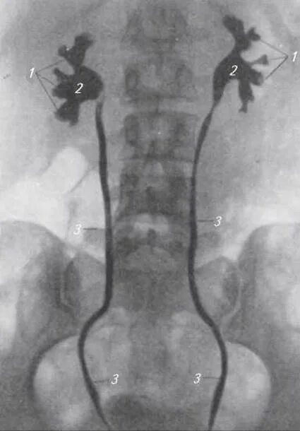 Экскреторная урография мочевого пузыря. Ретроградная пиелография пиелонефрит. Рентген анатомия мочевого пузыря. Конкремент мочеточника рентген.
