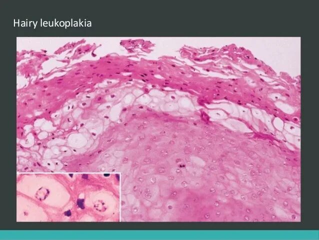 Гиперкератоз кожи гистология. Папилломатоз гистология. Лейкоплакия гистология. Веррукозная лейкоплакия. Лейкоплакия плоского эпителия.
