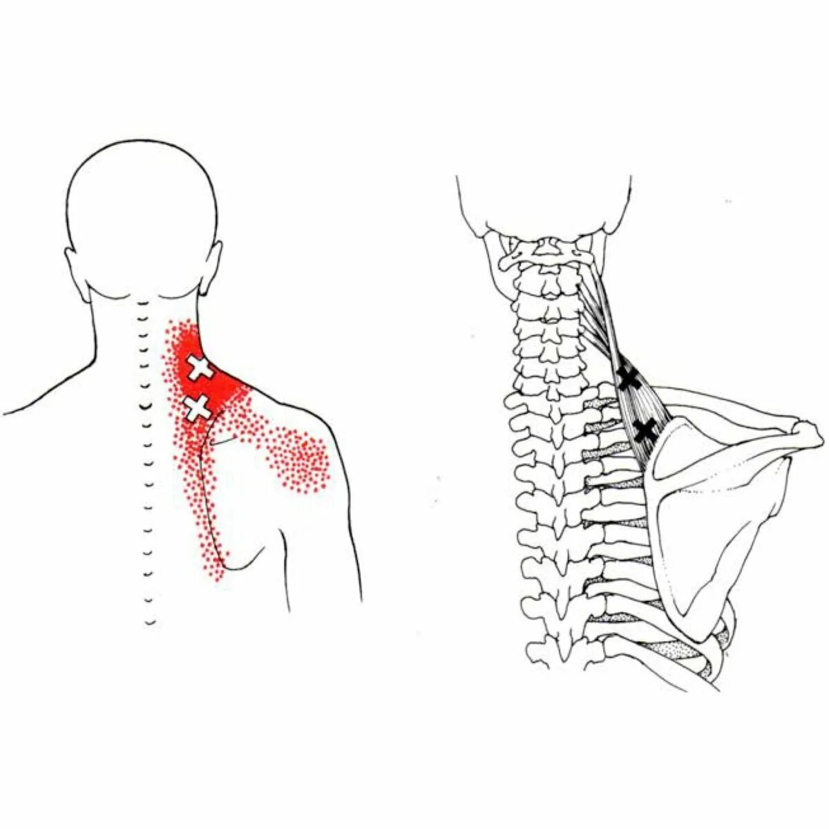 Подостная мышца триггерные точки. Болевые точки сзади. Триггерные точки лопатки. Миофасциальный синдром трапециевидной мышцы. Триггерные точки плеча и руки.