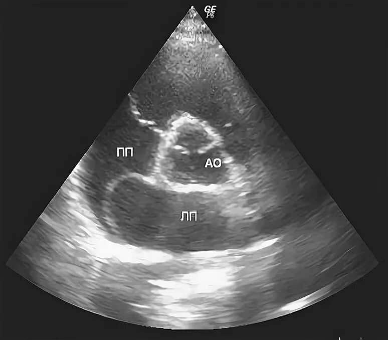 Функционирующее овальное. Аневризма межпредсердной перегородки ЭХОКГ. Открытое овальное окно эхокардиография. Открытое овальное окно на ЭХОКГ. Аневризма МПП на УЗИ.