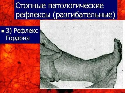 Рефлекс стопы
