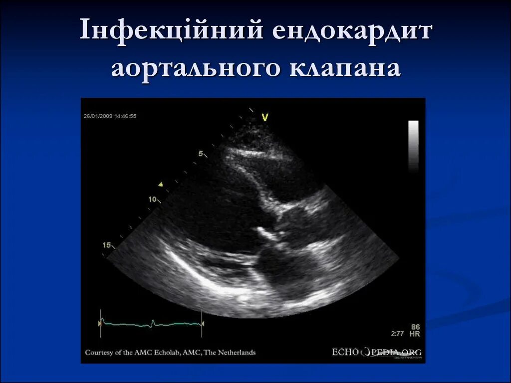 Кальциноз митрального клапана. Эндокардит митрального клапана УЗИ. Двухстворчатый аортальный клапан на ЭХОКГ. Вегетации на аортальном клапане ЭХОКГ.