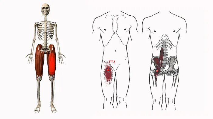 Приводящие мышцы триггерные точки. Приводящие мышцы бедра триггерные точки. Триггерные точки тазобедренного сустава.