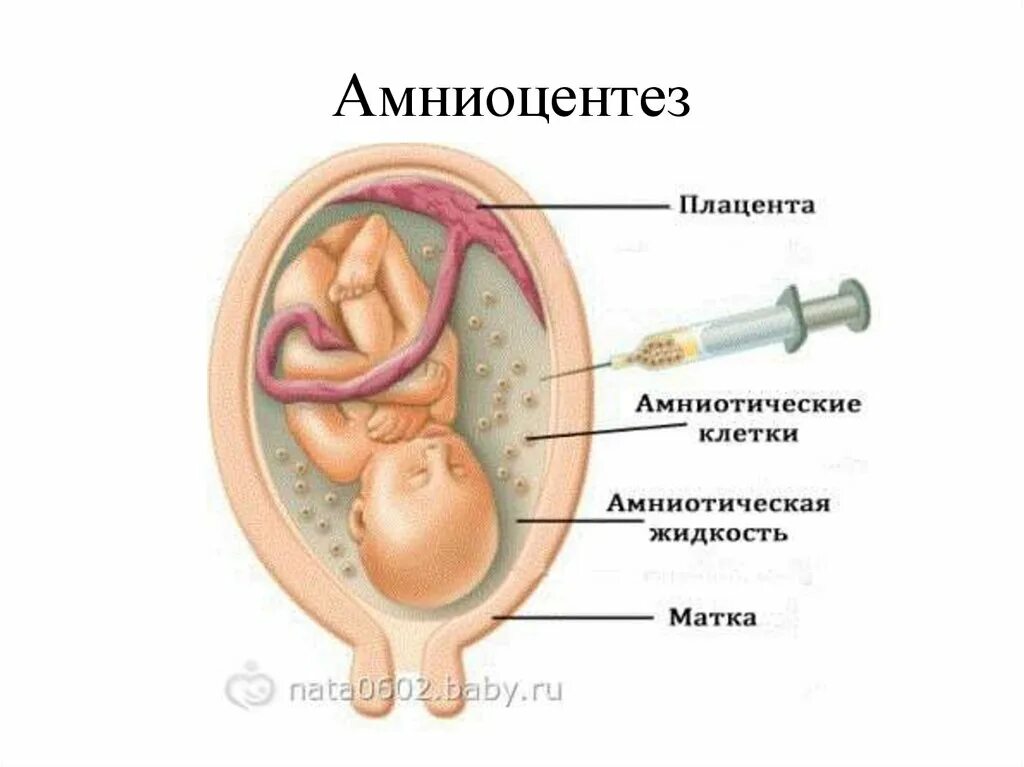 Амниоцентез при беременности. Абдоминальный амниоцентез.