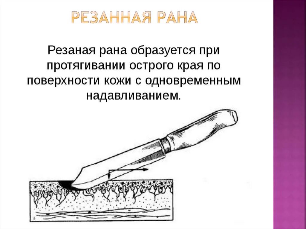 Резаные раны судебно медицинская экспертиза. Повреждения острыми предметами судебная медицина. Рубленная рана судебная медицина.