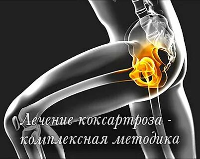 Лечение тазобедренного артроза народными средствами