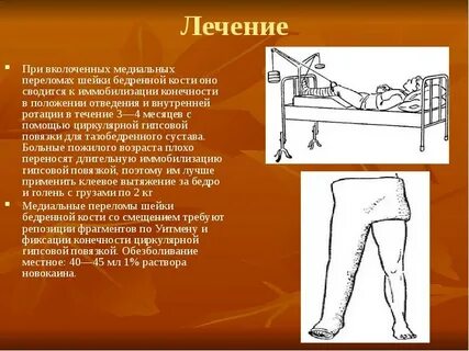 При переломе шейки бедра можно ходить