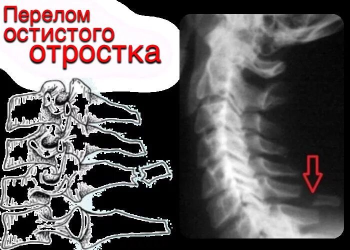 Мкб 10 открытый перелом. Перелом остистого отростка l1 позвонка. Перелом остистого отростка th12 позвонка. Перелом остистых отростков позвоночника мкб 10. Перелом остистого отростка позвонка поясничного отдела.