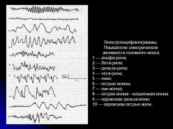 О чем говорит ээг. ЭЭГ Альфа бета тета Дельта ритмы. Альфа-активность мозга на ЭЭГ норма. Альфа ритм на ЭЭГ норма. ЭЭГ патологический Альфа ритм.