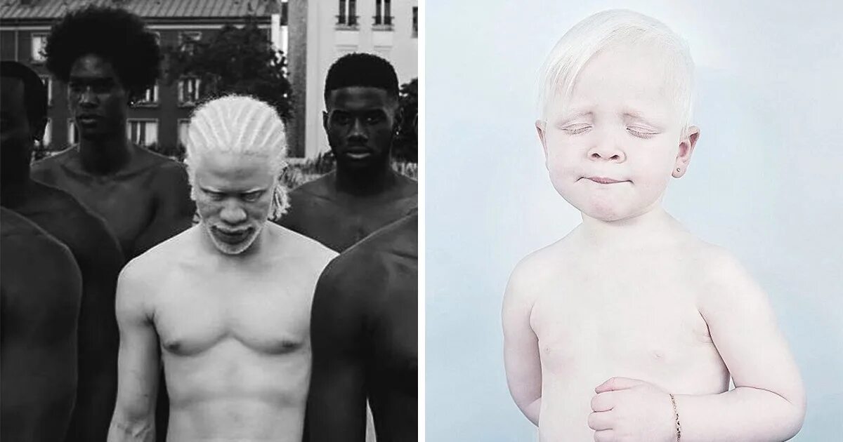 Что самое белое в черных людях. Альбинизм негроидная раса. Темнокожий альбинос.