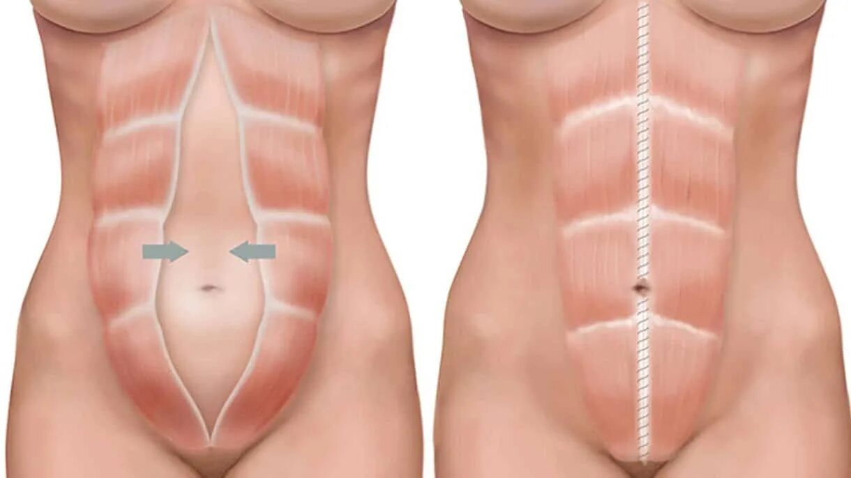 Прямая мышца живота у женщин. Диастаз мышц передней брюшной. Прямые мышцы живота диастаз. Диастаз (расхождение краев прямой мышцы живота),.