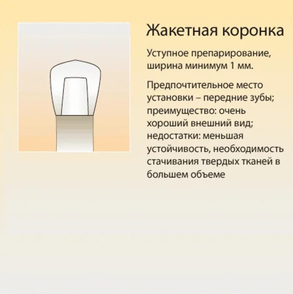 Фарфоровые коронки препарирование. Жакетная коронка уступ. комбинированные искусственные коронки препарирование. фарфоровые жакет-коронки.