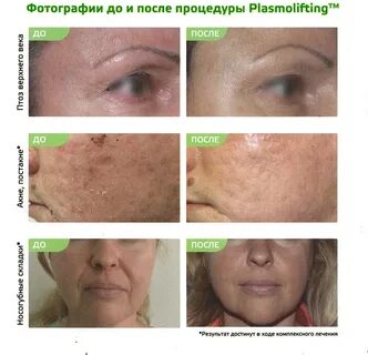 Плазма для лица отзывы