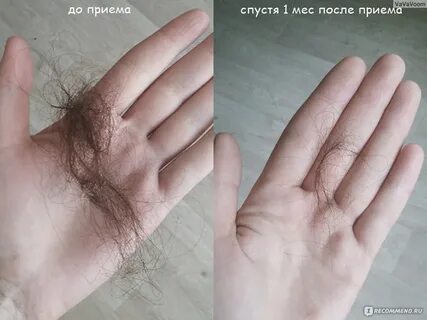 Норма выпадения волос у мужчин в день