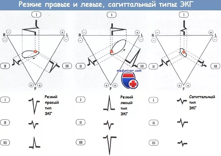 Что значит ось сердца горизонтальная. Электрическая ось сердца на экг левограмма. тип экг левый или правый тип. s тип эос на экг. электрическая ось сердца типа s1-s2-s3 на экг.