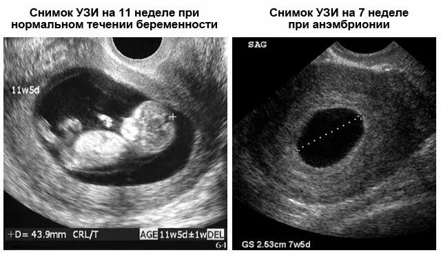 Срок видят эмбрион. Плодное яйцо 7 недель на узи в матке. анэмбриония – замершая беременность. неразвивающаяся беременность 7 недель узи. узи анэмбриония 7 недель.