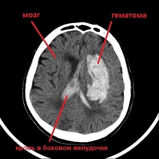 Кровоизлияние в желудочки. Кровоизлияние в ствол головного мозга на кт. Геморрагический инсульт гематома. Путаменальна гематома. Гематома ствола мозга кт.