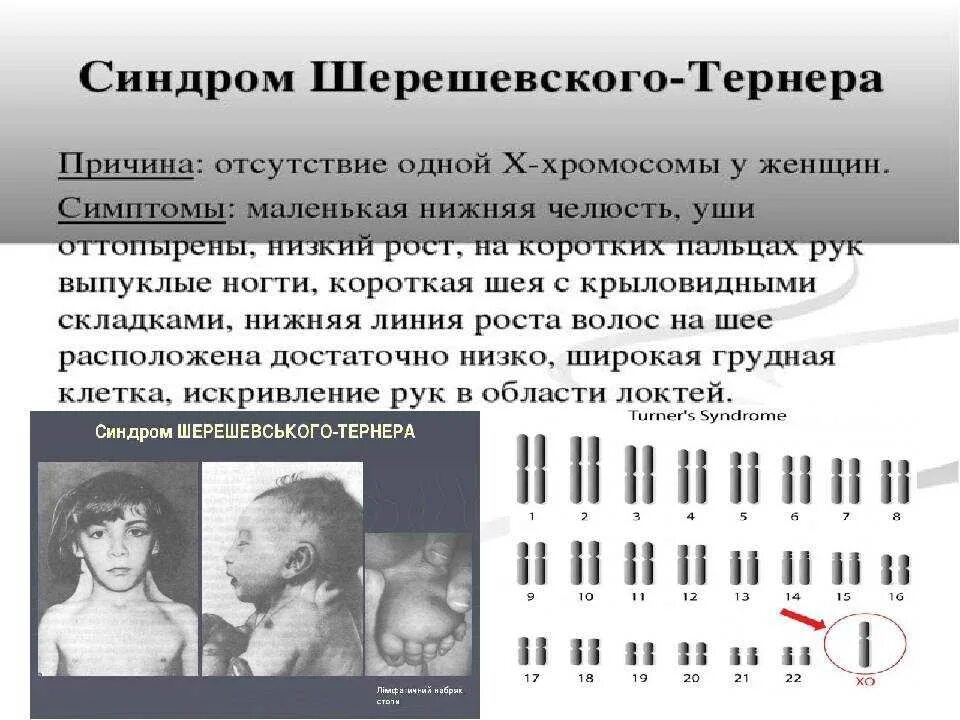 Синдром Шерешевского-Тернера (моносомия х-хромосомы). Генетика Шерешевского Тернера. Тип наследования Шерешевского Тернера. Заболевания по хромосомам.