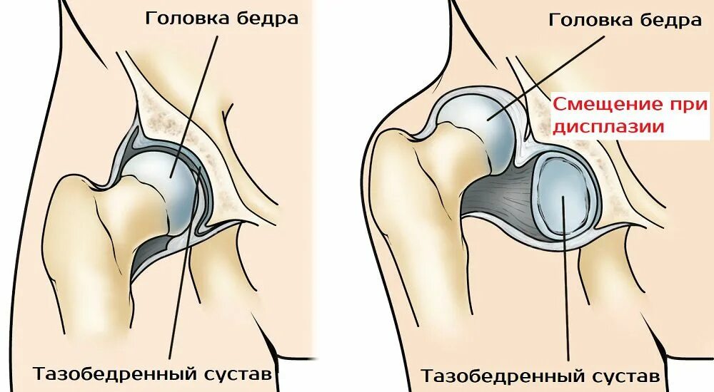 Вывих тазобедренного сустава мкб 10. Дисплазия головки бедренной кости. дисплазия головок бедренных костей. вывих шейки тазобедренного сустава. дисплазия блока бедренной кости.