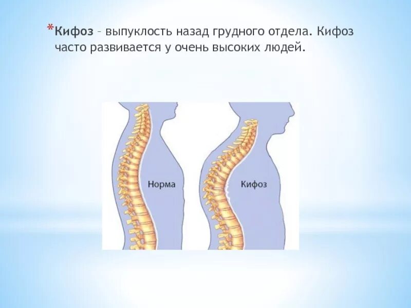 Что такое кифоз грудного отдела грудного отдела. Физиологический грудной кифоз. Кифоз причины возникновения.