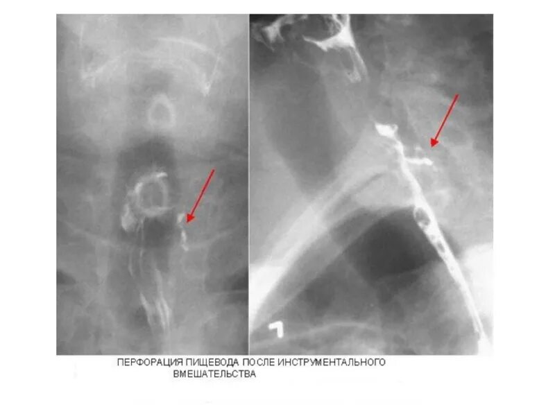 Перфорация пищевода рентгенограмма. Контрастирование пищевода барием. Спонтанный разрыв пищевода симптомы. Контрастирование пищевода рентген.