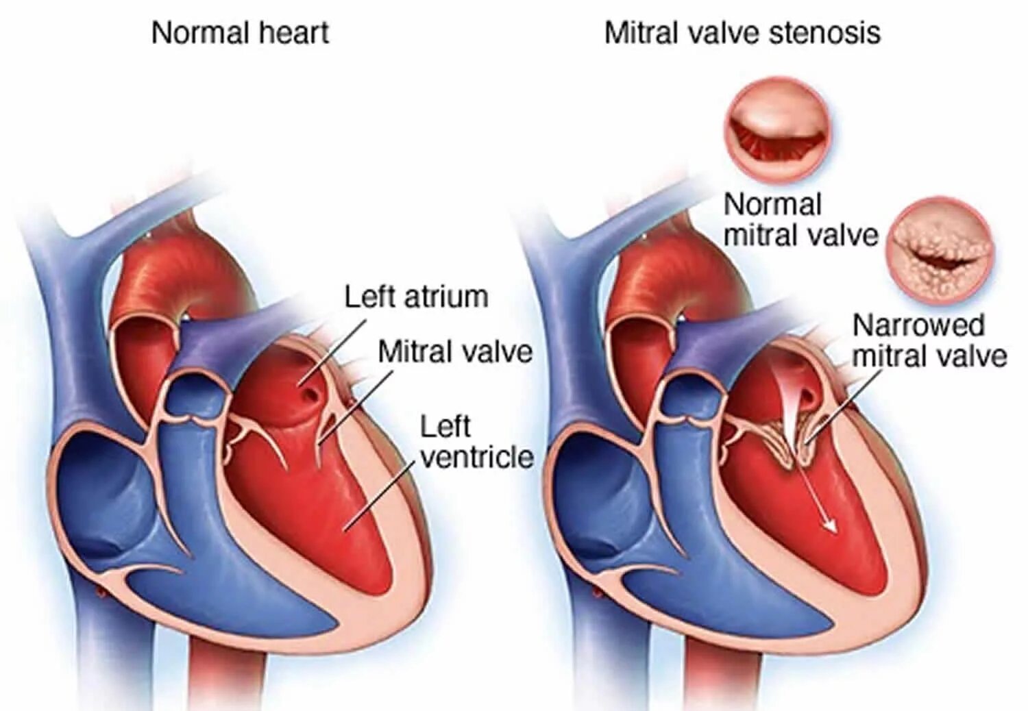 Ревматический митральный стеноз. Дефекты сердечных клапанов. Левое предсердие увеличено