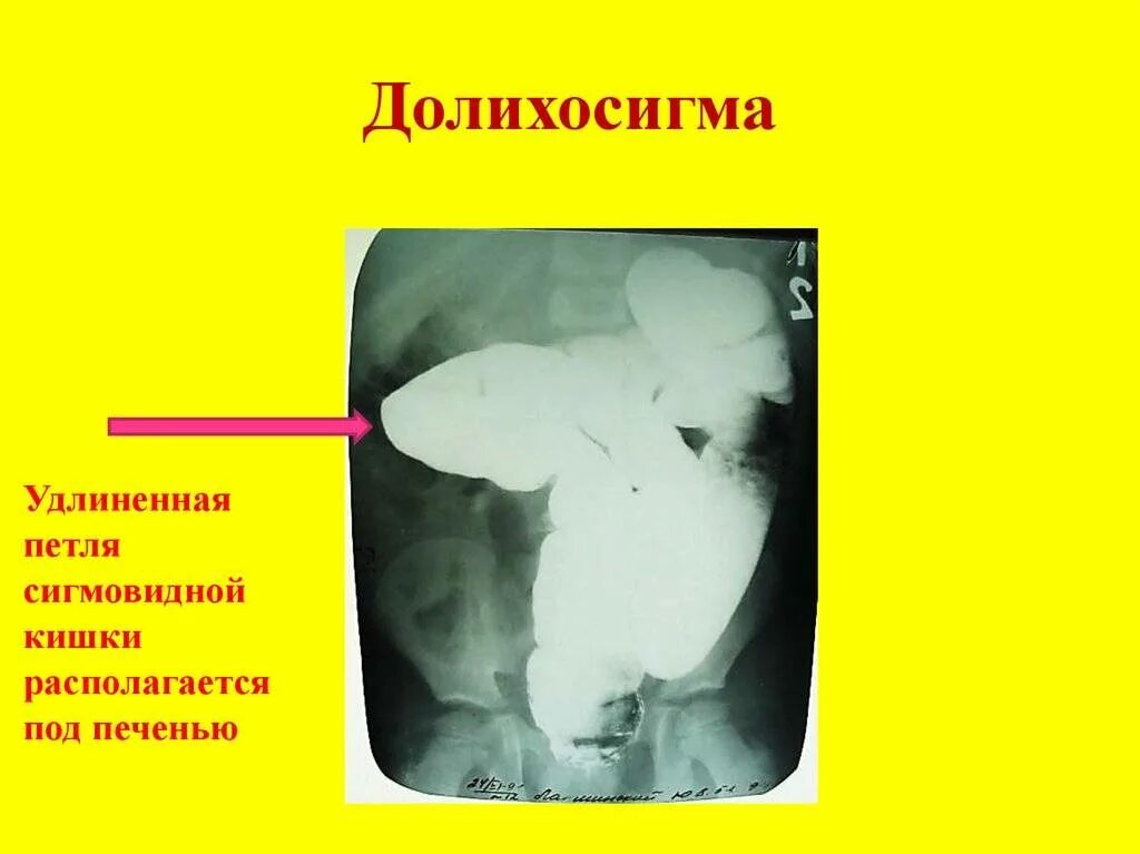 Дополнительная петля в кишечнике. Удлиненная сигмовидная