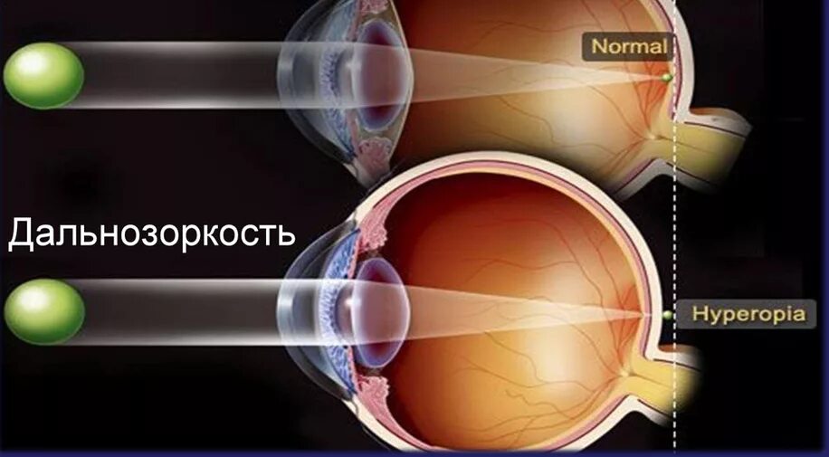 Глаз при дальнозоркости. Дальнозоркость глаз. 4 степень гиперметропии. При дальнозоркости изображение предмета фокусируется. Дальнозоркость и близорукость строение глаза.