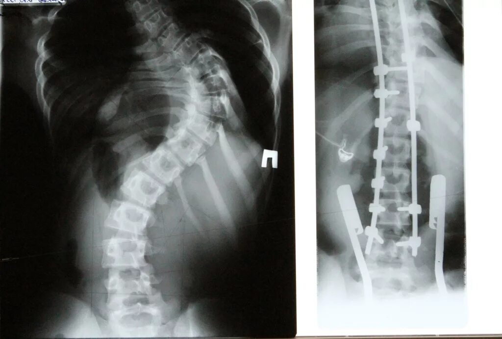 Операция на позвоночник сколько времени. Металлоконструкция в позвоночнике. Операция на позвоночник при сколиозе. Операция на позвоночник с металлоконструкцией.