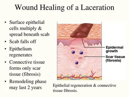 Wound healing