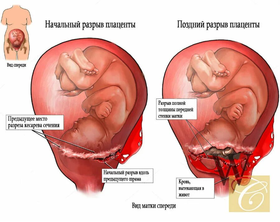 Разрыв матки при беременности.