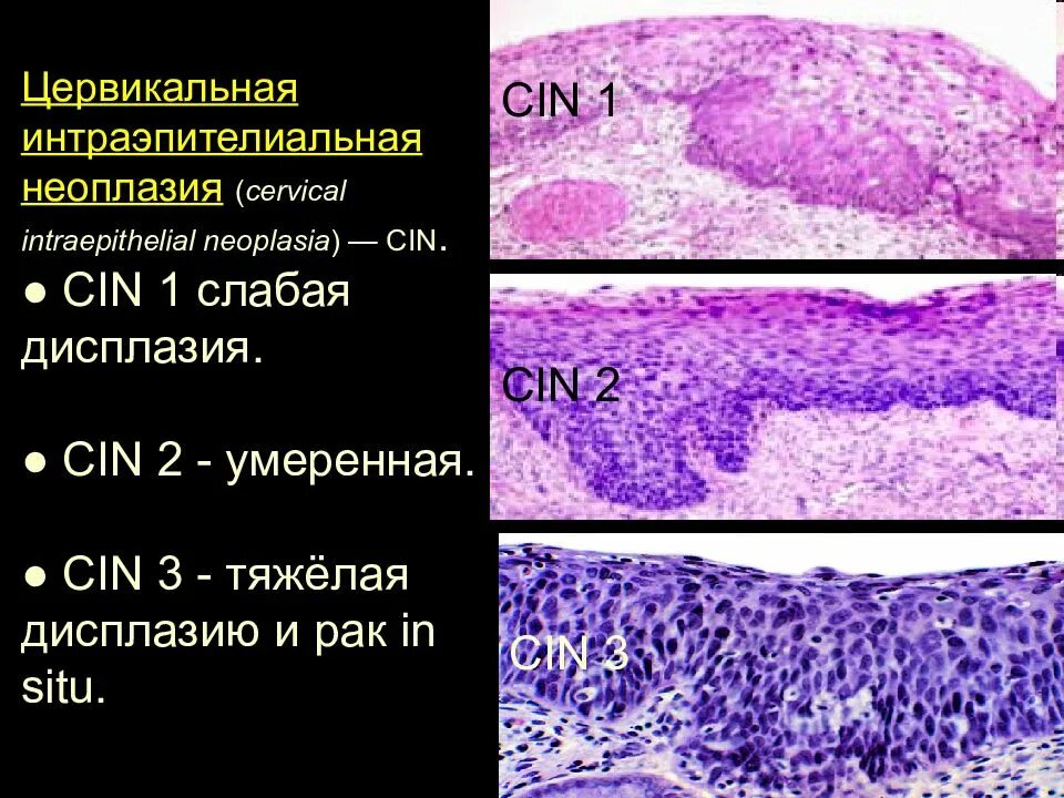 Что означает интраэпителиальное поражение