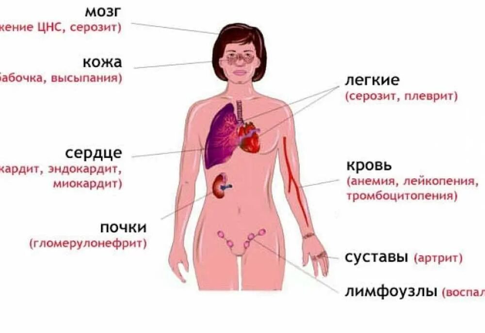 Сыпь лимфоузлы температура. Системная красная волчанка симптомы на коже. Красная системная волчанка признаки. Клинические проявления СКВ. Системная красная волчанка симптомы причины.