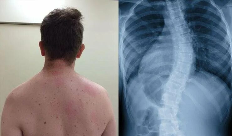 Кифосколиоз шейного отдела позвоночника. Склероз 3 степени. Грудопоясничный сколиоз 3 степени s образный. Сколиотическая деформация шейного отдела позвоночника. Склероз 3 степени.