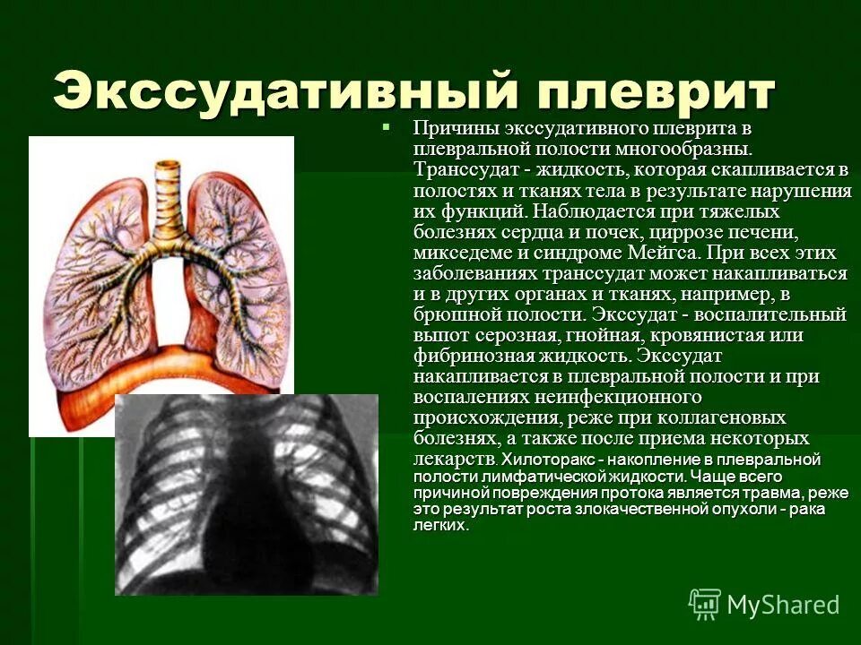 Правосторонний экссудативный плеврит. Экссудативный плеврит причины. Транссудативный плеврит это.