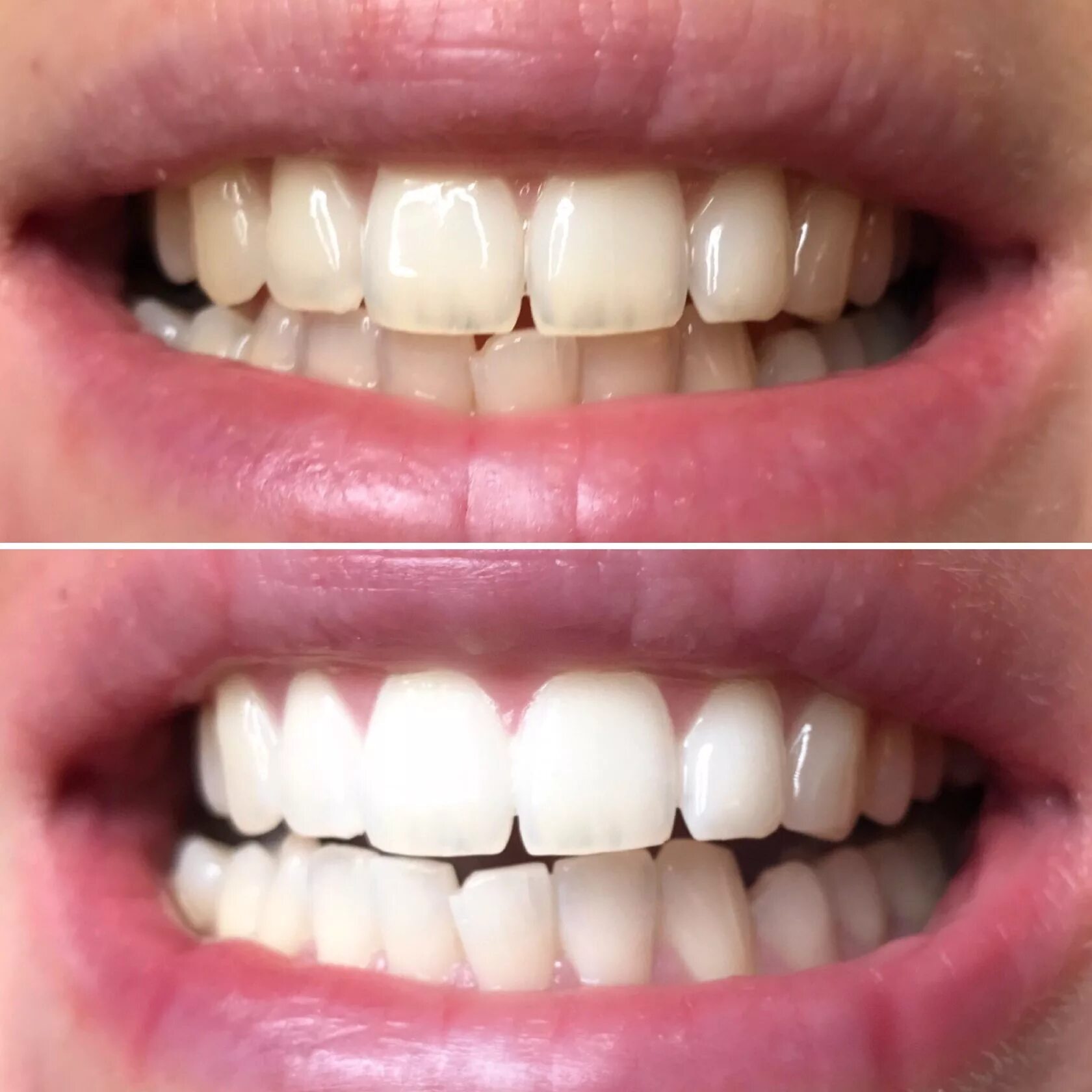 Ортодонт люкс. Отбеливание калининград. Горшее зубы. Отбеливание opalescence boost. Отбеливание калининград.