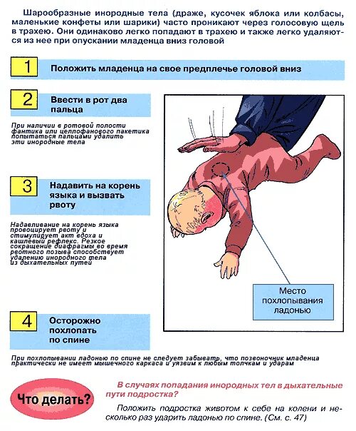 сдавливание дыхательных путей. прием генри геймлиха. обструкция дыхат. подавился метод геймлиха. приемы для освобождения верхних дыхательных путей.
