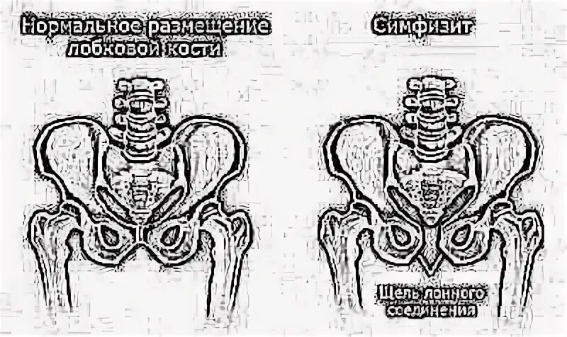 Симфизит после родов форум