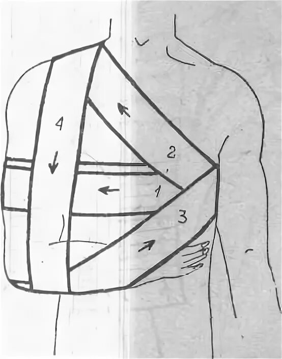 Плечевая повязка алгоритм. Повязка Дезо бинтом. Повязка Дезо алгоритм. Дезо бинтование бинтование повязка. Дезо повязка бинтом алгоритм.