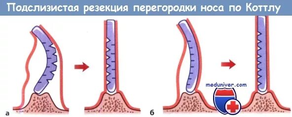 Подслизистая резекция перегородки. Подслизистая резекция по Киллиану. Подслизистая резекция носовой перегородки. Субслизистая резекция перегородка носа. Носовая перегородка код по мкб 10