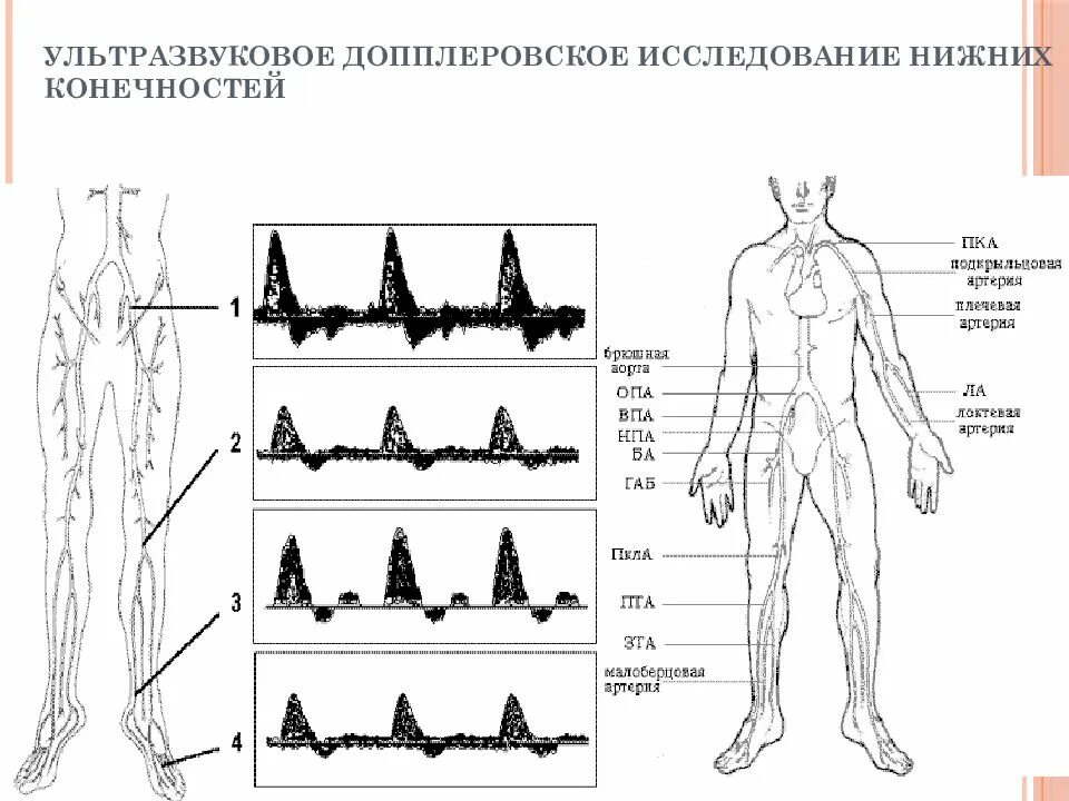 Доплер нижних конечностей. УЗДГ артерий нижних конечностей расшифровка. Ультразвуковая допплерография нижних конечностей. Ультразвуковое допплеровское исследование нижних конечностей. УЗИ артерий нижних конечностей протокол.