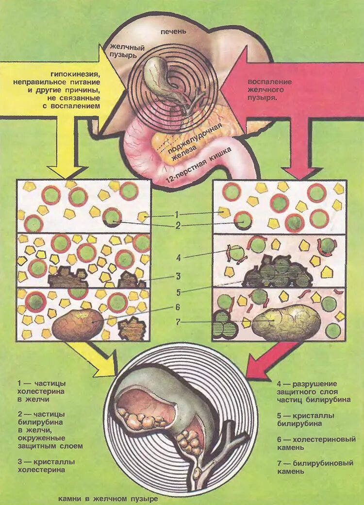 Холестерин в желчном пузыре. Схема образования камней в желчном пузыре. Схема патогенеза образования желчных камней. Схема камнеобразования в желчном пузыре. Схема формирования желчных камней.