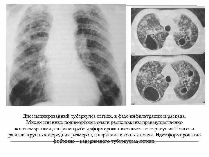 Диссеминированный туберкулез легких фазы. Диссеминированный туберкулез в фазе инфильтрации. Диссеминированный туберкулез фазы. Диссеминированный туберкулез на кт. Диссеминированный туберкулез в фазе инфильтрации и распада.